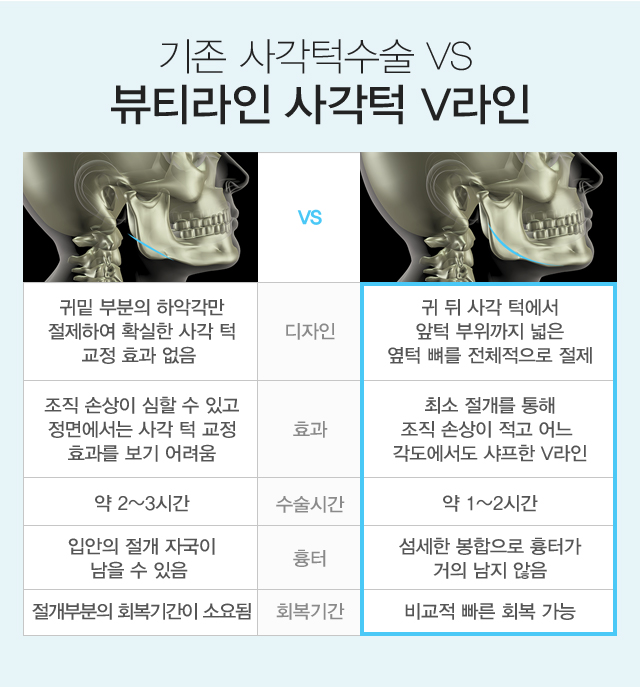 기존 사각턱수술 vs 뷰티라인 사각턱 V라인 비교