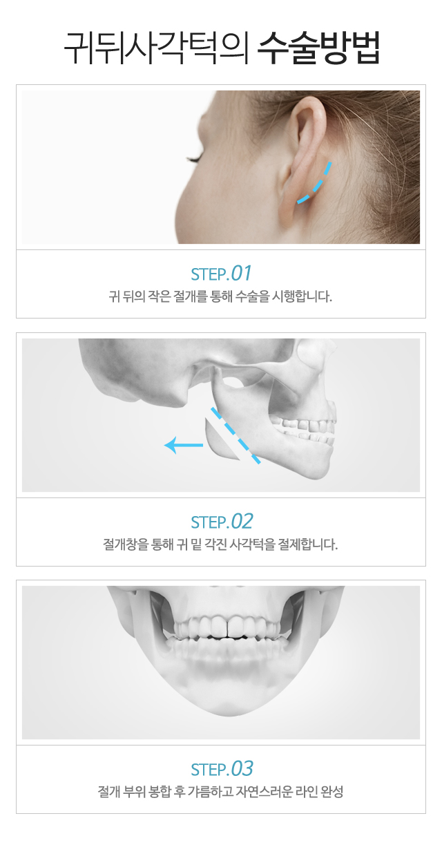 귀뒤사각턱의 수술방법:1)귀 뒤의 작은 절개를 통해 수술을 시행합니다. 2)절개창을 통하여 귀 밑 각진 사각턱을 절제합니다. 3)절개 부위 봉합 후 갸름하고 자연스러운 라인 완성