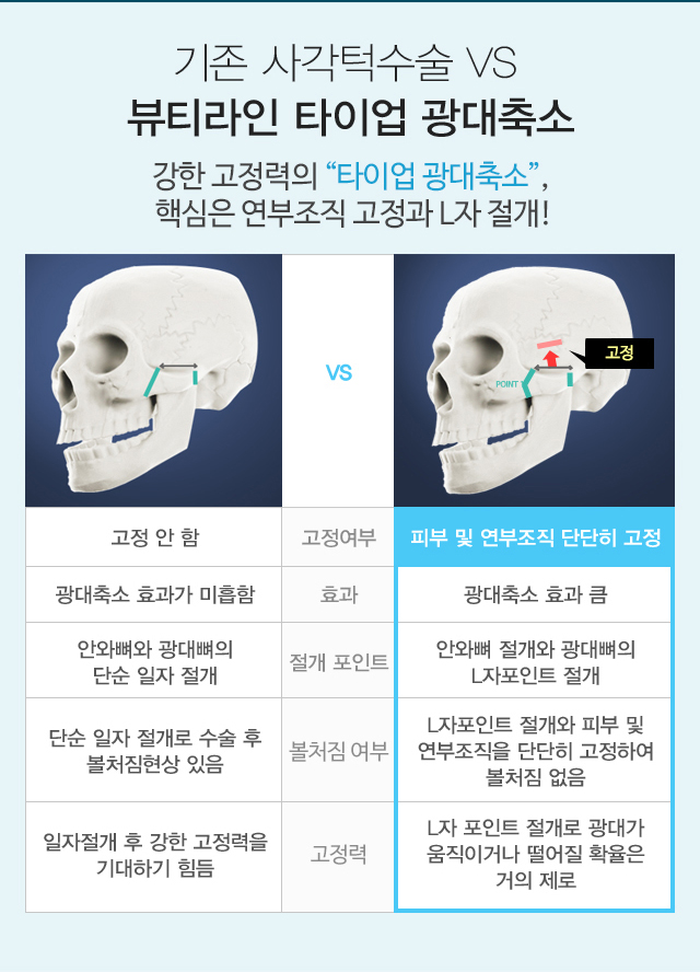 기존 사각턱수술 vs 뷰티라인 타이업 광대축소 비교